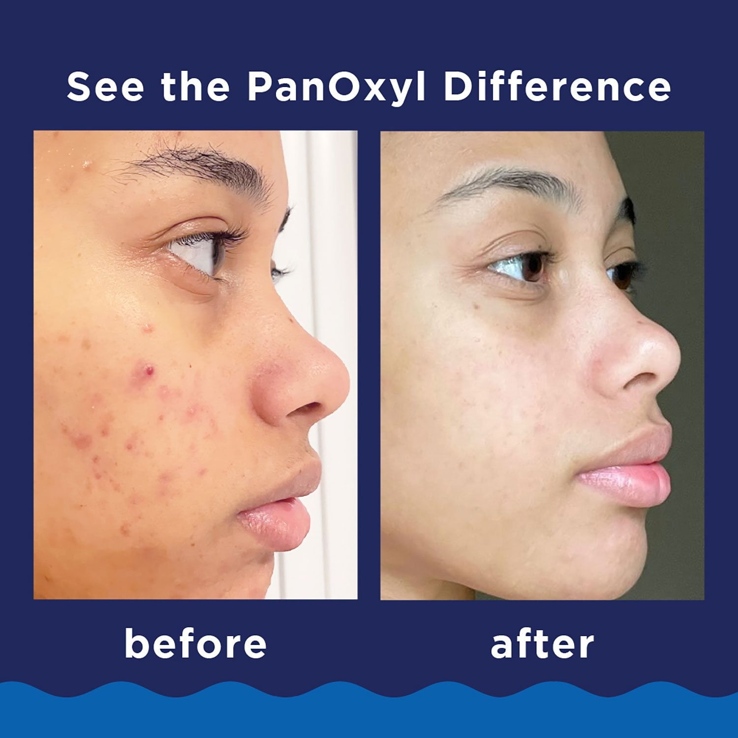 PanOxyl Acne Foaming Wash, 10% Benzoyl Peroxide, 5.5 oz., 2 pk.